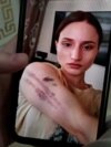 Фотография погибшей в Армении уроженки Чечни Айшат Баймурадовой со следами домашнего насилия